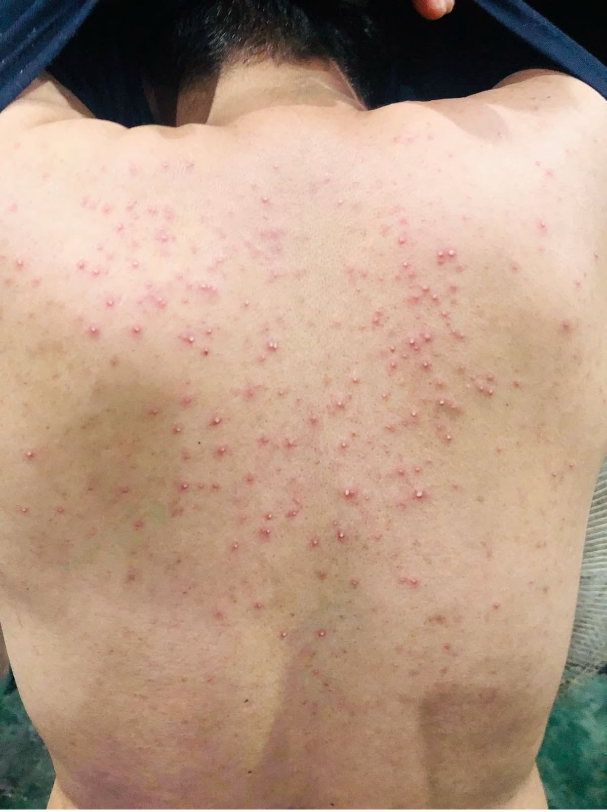 Body Acne?